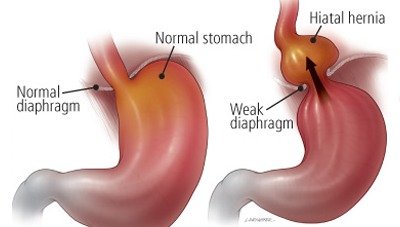 Anti-reflux surgery for GERD and Hiatus Hernia