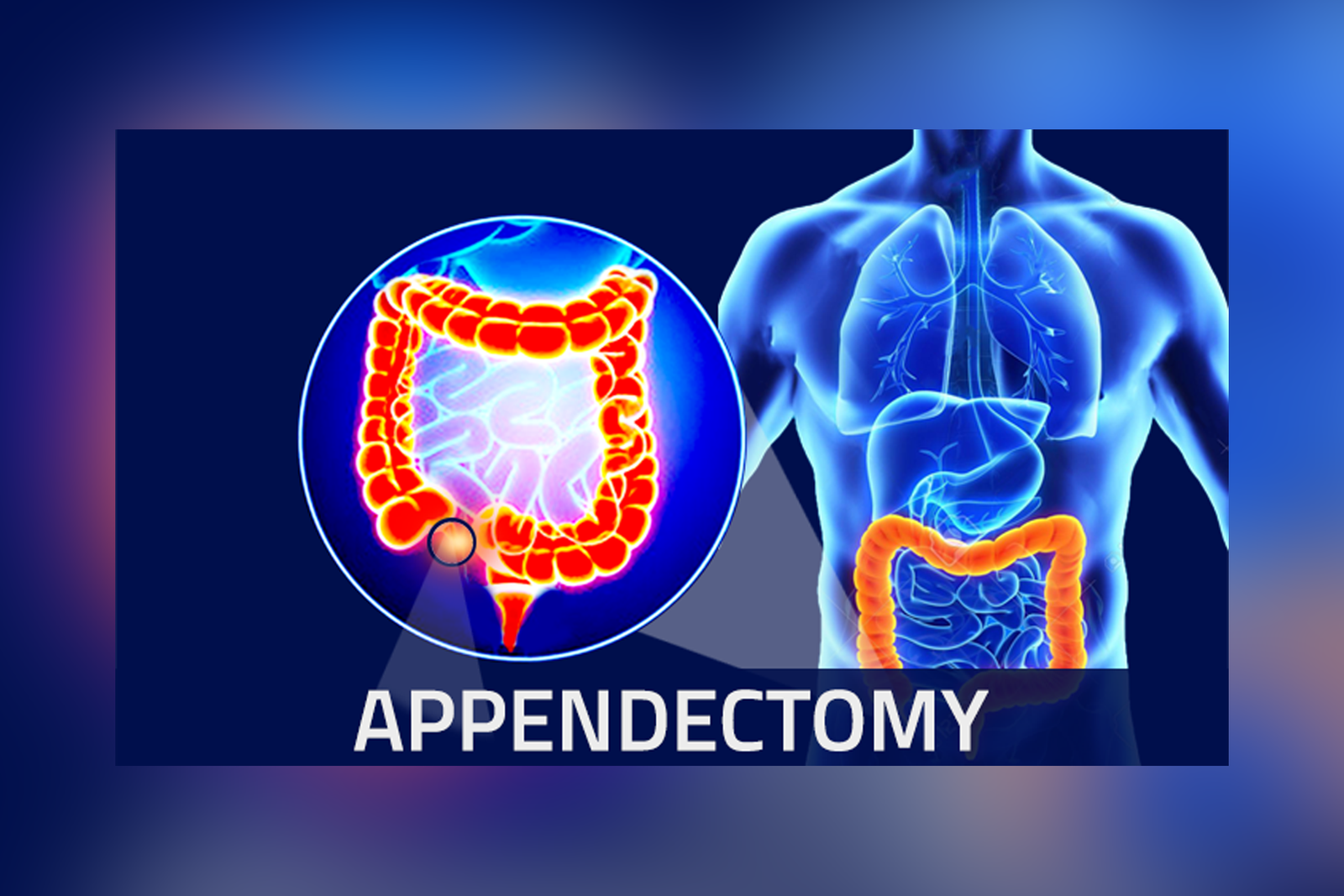 Gastrointestinal surgeries