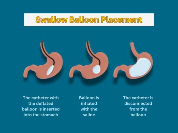 Swallow balloon for weight loss