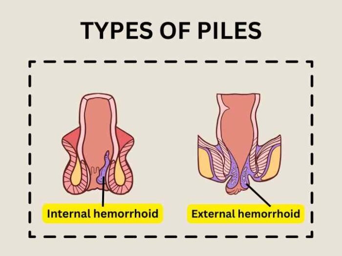 types of piles