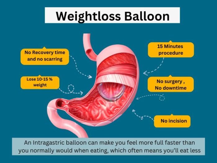 swallow balloon for weight loss