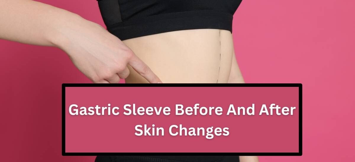 Gastric Sleeve Before And After Skin Changes