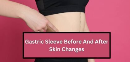 Gastric Sleeve Before And After Skin Changes