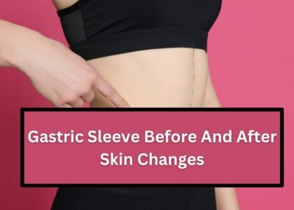 Gastric Sleeve Before And After Skin Changes