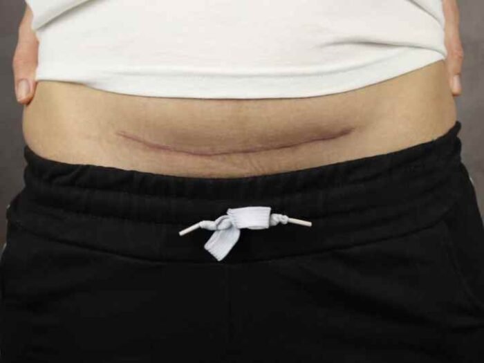 Bariatric Surgery Scars