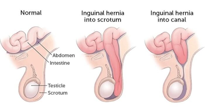 Hernia Surgery Cost